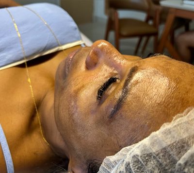 Depois do tratamento: Limpeza de pele, registro feito logo após a sessão. Poros desobstruídos e pele preparada para absorver melhor o skincare.