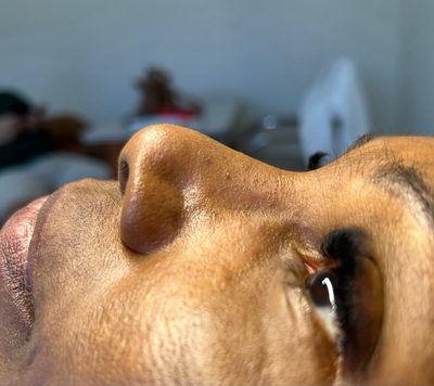 Antes do tratamento: Outra limpeza de pele registrada na hora. O brilho é resposta natural da pele ao procedimento recém-realizado.