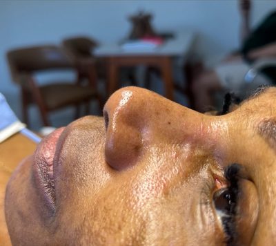 Depois do tratamento: Outra limpeza de pele registrada na hora. O brilho é resposta natural da pele ao procedimento recém-realizado.