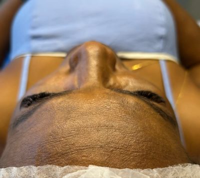 Antes do tratamento: Registro durante a sessão de limpeza de pele, com o ativo ainda aplicado. É o procedimento acontecendo, não o resultado.