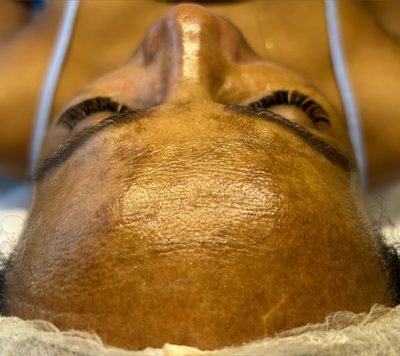Depois do tratamento: Registro durante a sessão de limpeza de pele, com o ativo ainda aplicado. É o procedimento acontecendo, não o resultado.