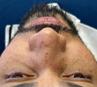 Antes do tratamento: Acne e manchas pós-acne, em acompanhamento. Protocolo ajustado ao tipo de pele e à fase da acne.