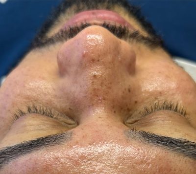 Depois do tratamento: Acne e manchas pós-acne, em acompanhamento. Protocolo ajustado ao tipo de pele e à fase da acne.