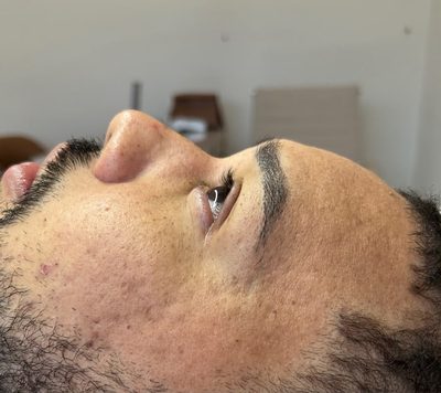 Antes do tratamento: Acne e marcas em paciente masculino, em acompanhamento.