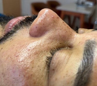 Depois do tratamento: Acne e marcas em paciente masculino, em acompanhamento.