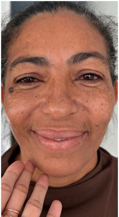 Antes do tratamento: Evolução de paciente que nunca havia realizado tratamentos estéticos, com melhora na uniformidade da pele e na intensidade do melasma. Este ainda não é o resultado final.