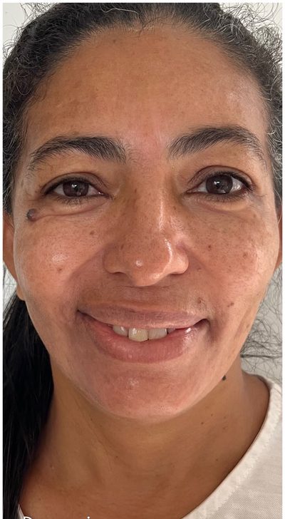 Depois do tratamento: Evolução de paciente que nunca havia realizado tratamentos estéticos, com melhora na uniformidade da pele e na intensidade do melasma. Este ainda não é o resultado final.