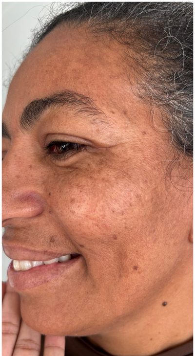 Antes do tratamento: Melasma facial, em acompanhamento. Protetor solar e tratamento domiciliar entre as sessões.