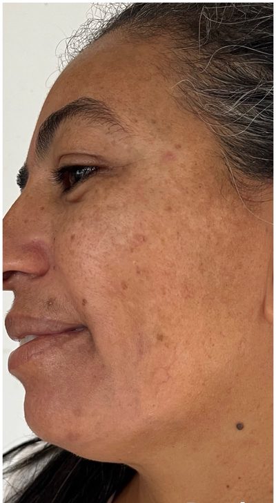 Depois do tratamento: Melasma facial, em acompanhamento. Protetor solar e tratamento domiciliar entre as sessões.