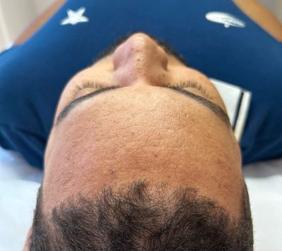 Antes do tratamento: Acne na região frontal, com foco em textura e uniformidade da pele.
