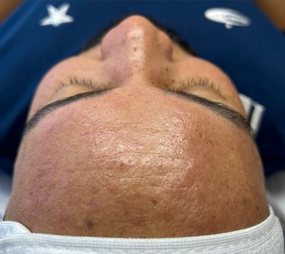 Depois do tratamento: Acne na região frontal, com foco em textura e uniformidade da pele.
